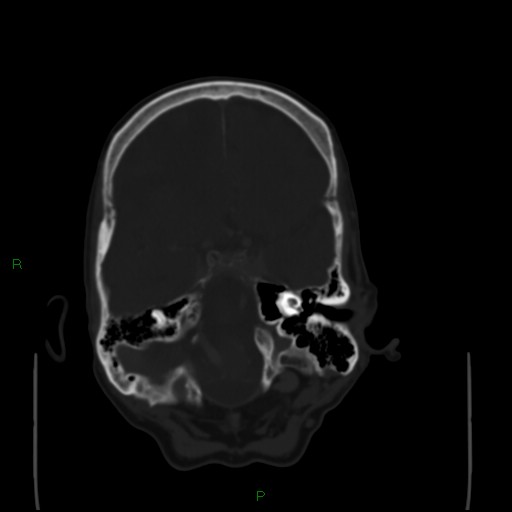 Cerebral metastases - breast primary (Radiopaedia 77653-89857 Axial bone window 34).jpg