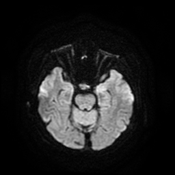 Cerebral metastases - melanoma (Radiopaedia 80972-94522 Axial DWI 44).jpg