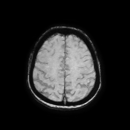 Cerebral metastases - melanoma (Radiopaedia 80972-94522 Axial SWI 76).jpg