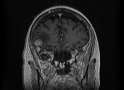 Cerebral metastases from lung cancer with amyloid angiopathy and cerebellopontine angle meningioma (Radiopaedia 74306-85191 Coronal T1 C+ 15).jpg