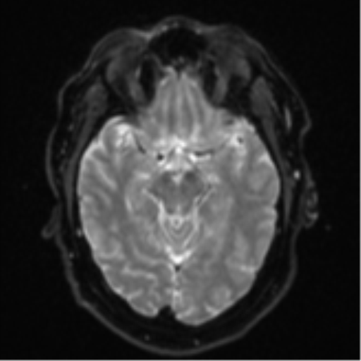 File:Cerebral metastases mimicking multifocal glioblastoma (Radiopaedia 50843-56353 Axial DWI 11).png