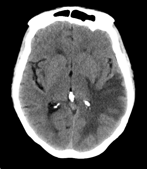 File:Cerebral metastasis (Radiopaedia 46744-51247 Axial non-contrast 15).png