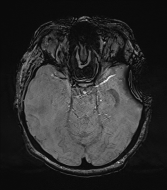 File:Cerebral metastasis to basal ganglia (Radiopaedia 81568-95413 Axial SWI 30).png