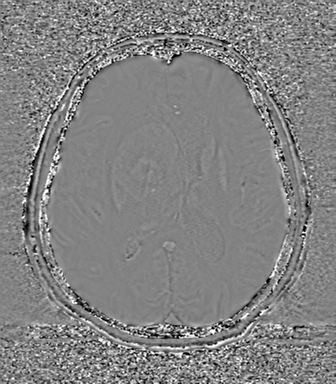 Cerebral metastasis to basal ganglia (Radiopaedia 81568-95413 Axial SWI phase 49).png