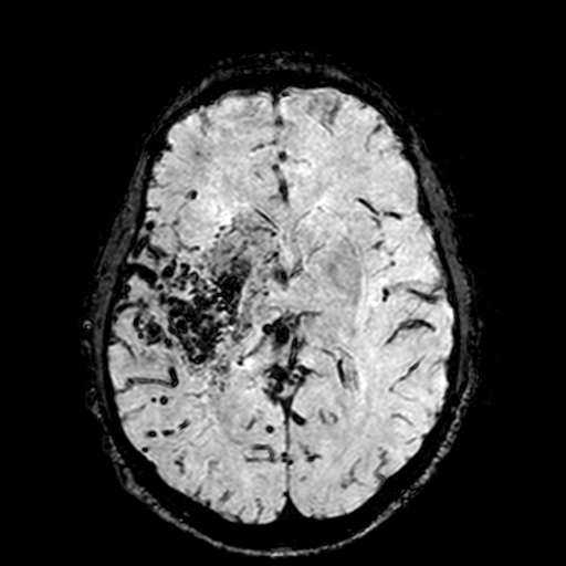 Cerebral parenchymal arteriovenous malformation (Radiopaedia 27280-27456 Axial SWI 61).jpg