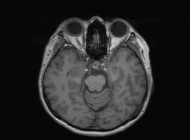 Cerebral ring enhancing lesions - cerebral metastases (Radiopaedia 44922-48817 Axial T1 268).jpg