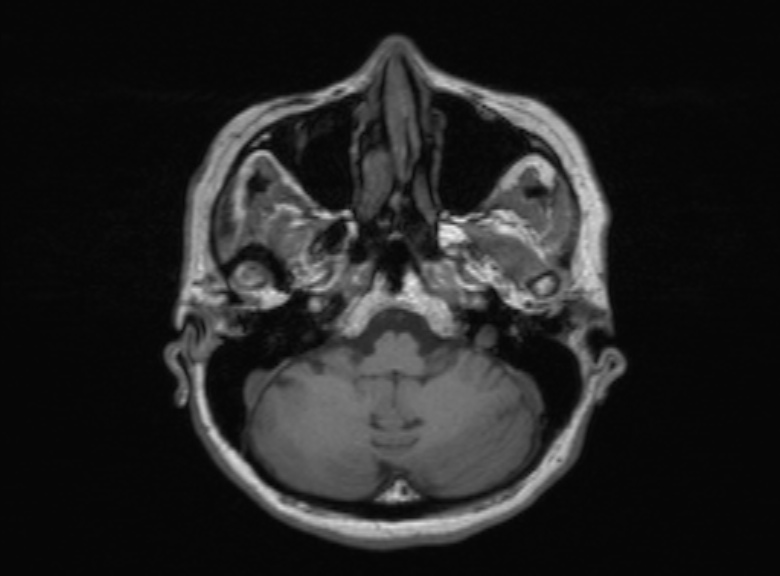 Cerebral ring enhancing lesions - cerebral metastases (Radiopaedia 44922-48817 Axial T1 316).jpg