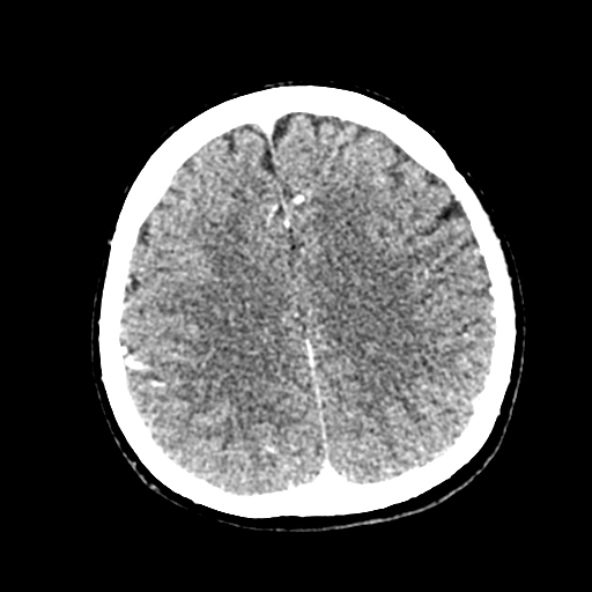 Cerebral ring enhancing lesions - cerebral metastases (Radiopaedia 44922-48818 B 195).jpg