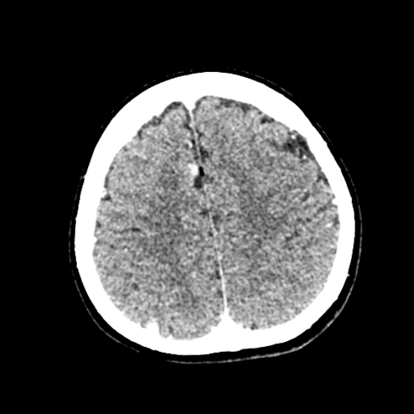 Cerebral ring enhancing lesions - cerebral metastases (Radiopaedia 44922-48818 B 216).jpg