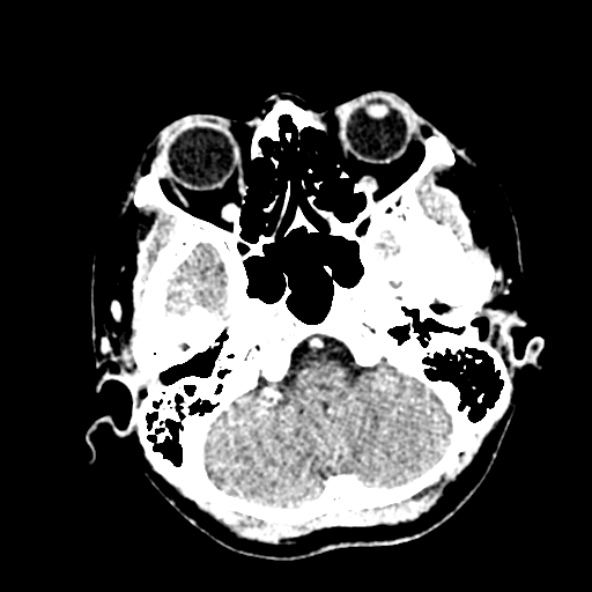 Cerebral ring enhancing lesions - cerebral metastases (Radiopaedia 44922-48818 B 58).jpg