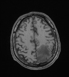 File:Cerebral toxoplasmosis (Radiopaedia 43956-47461 Axial T1 61).jpg