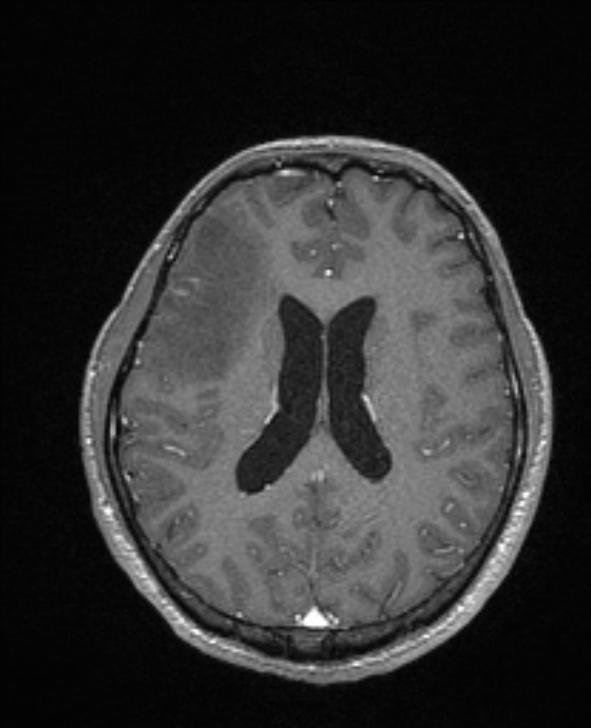Cerebral toxoplasmosis (Radiopaedia 85779-101597 Axial T1 C+ 100).jpg