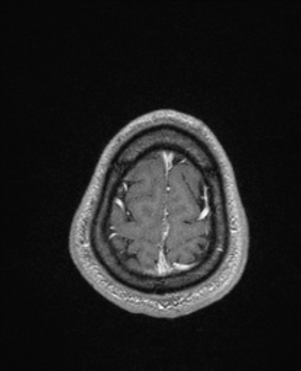 Cerebral toxoplasmosis (Radiopaedia 85779-101597 Axial T1 C+ 146).jpg