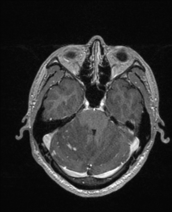 Cerebral toxoplasmosis (Radiopaedia 85779-101597 Axial T1 C+ 49).jpg