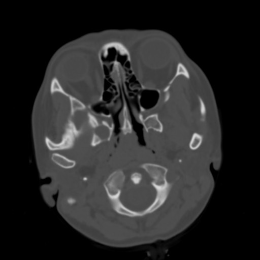 Cerebral tuberculosis with dural sinus invasion (Radiopaedia 60353-68018 Axial bone window 2).jpg