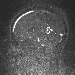 Cerebral tuberculosis with dural sinus invasion (Radiopaedia 60353-68090 Sagittal MRV 74).jpg