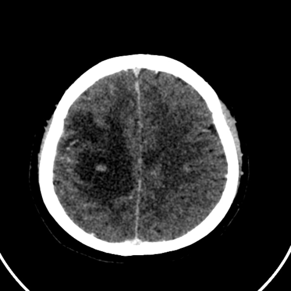 Cerebral venous hemorrhagic infarct from venous sinus thrombosis (Radiopaedia 55433-61883 Axial C+ delayed 42).jpg