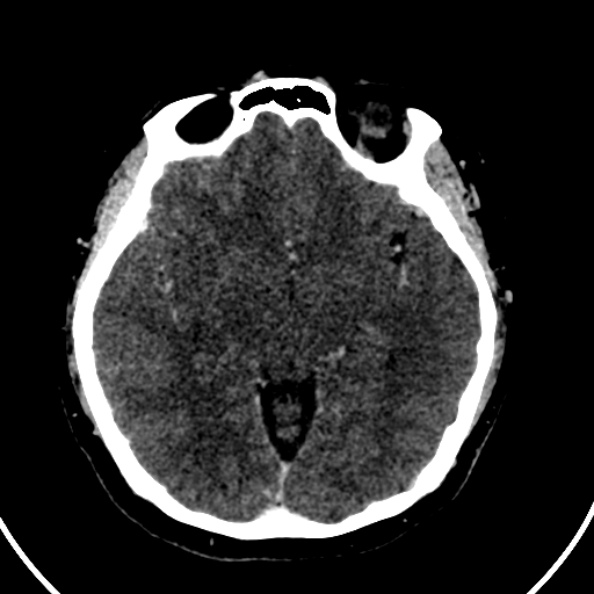 File:Cerebral venous hemorrhagic infarct from venous sinus thrombosis (Radiopaedia 55433-61883 Axial C+ delayed 86).jpg