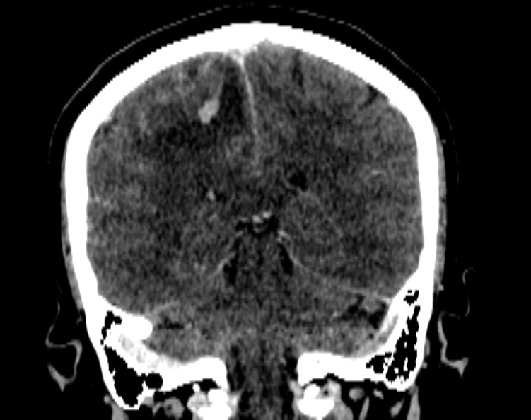 Cerebral venous hemorrhagic infarct from venous sinus thrombosis (Radiopaedia 55433-61883 Coronal C+ delayed 41).jpg