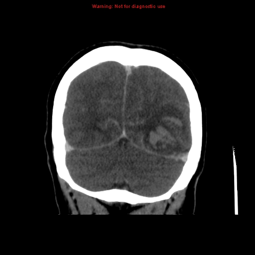 Cerebral venous infarction (Radiopaedia 12404-20735 B 67).jpg