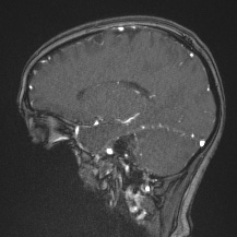 Cerebral venous infarction - hemorrhagic (Radiopaedia 81625-95505 Sagittal MRV 49).jpg