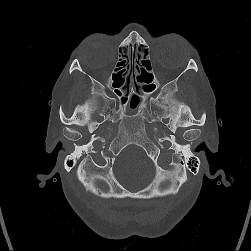 Cerebral venous infarction with hemorrhage (Radiopaedia 65343-74381 Axial bone window 11).jpg