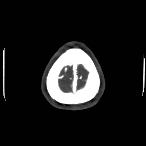 Cerebral venous sinus thrombosis (Radiopaedia 40619-43227 A 218).jpg