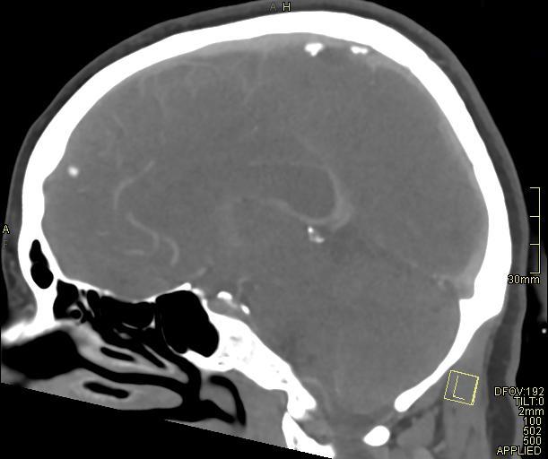 Cerebral venous sinus thrombosis (Radiopaedia 91329-108965 Sagittal venogram 36).jpg