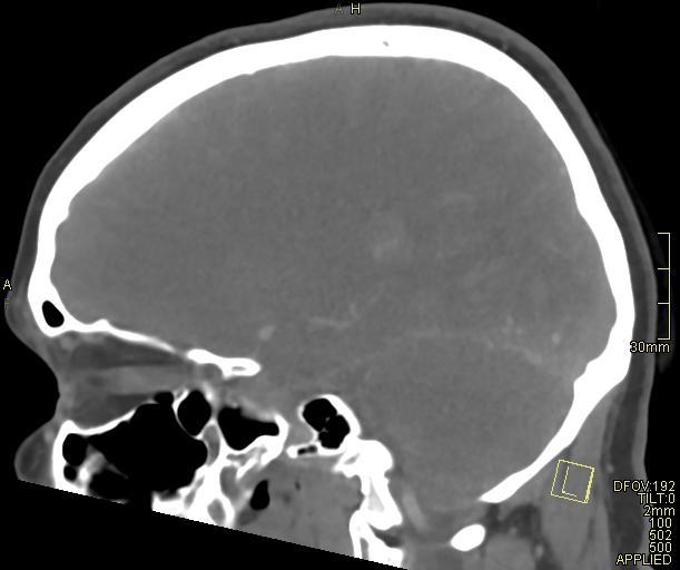 Cerebral venous sinus thrombosis (Radiopaedia 91329-108965 Sagittal venogram 47).jpg
