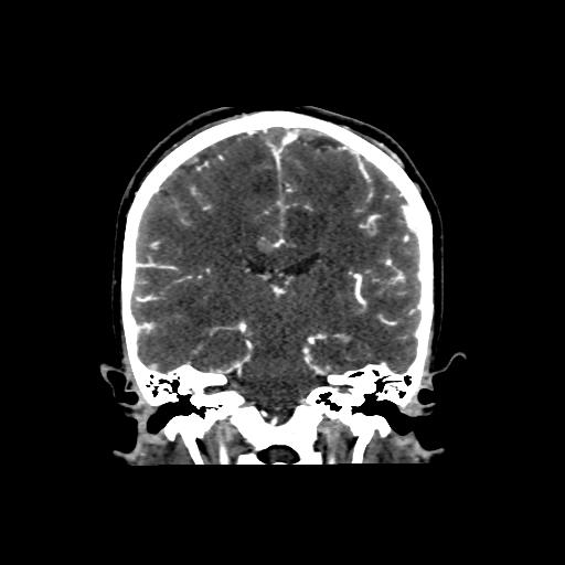 File:Cerebral venous throbmosis - hemorrhagic venous infarction (Radiopaedia 87318-103613 Coronal CT venogram 21).jpg