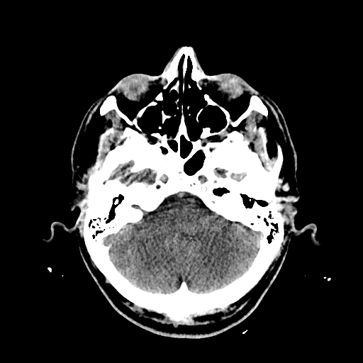 File:Cerebral venous thrombosis (CVT) (Radiopaedia 77524-89685 Axial non-contrast 10).jpg