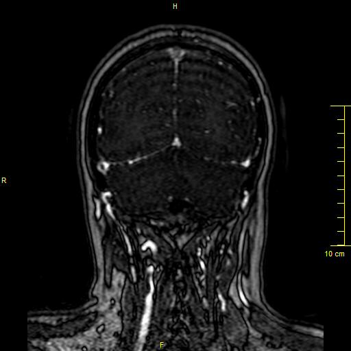 Cerebral venous thrombosis (Radiopaedia 23288-23351 MRV 137).JPG
