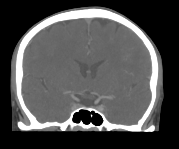 Cerebral venous thrombosis (Radiopaedia 38392-40467 Coronal CTA-Venogram 28).png