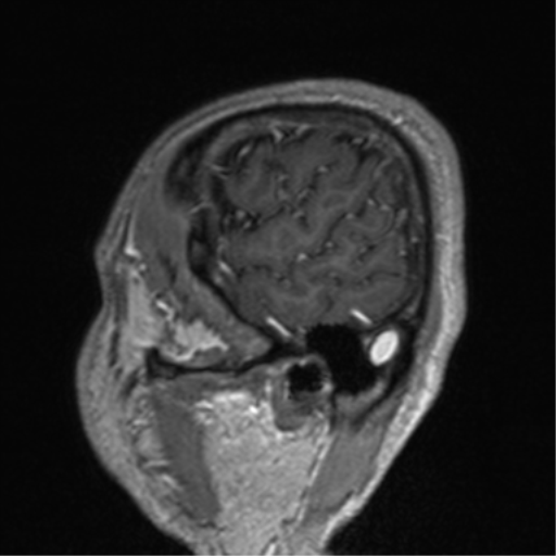 Cerebral venous thrombosis (Radiopaedia 38392-40469 Sagittal T1 C+ 77).png