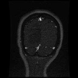 Cerebral venous thrombosis - ulcerative colitis (Radiopaedia 66049-75219 Coronal MRV 19).jpg