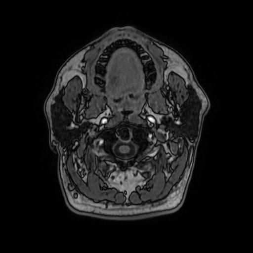File:Cerebral venous thrombosis with secondary intracranial hypertension (Radiopaedia 89842-106957 Axial T1 C+ 22).jpg