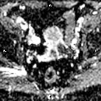 File:Cervical adenocarcinoma (Radiopaedia 65011-73985 Axial ADC 18).jpg