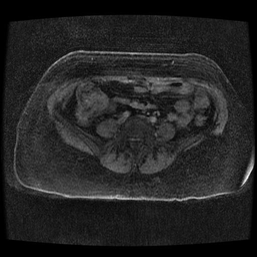 File:Cervical carcinoma (Radiopaedia 70924-81132 Axial T1 C+ fat sat 174).jpg