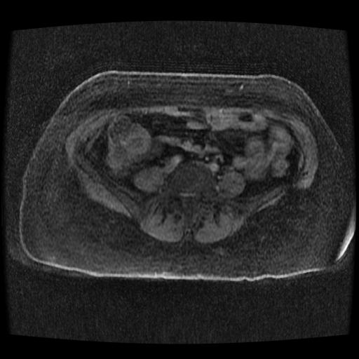 Cervical carcinoma (Radiopaedia 70924-81132 Axial T1 C+ fat sat 262).jpg
