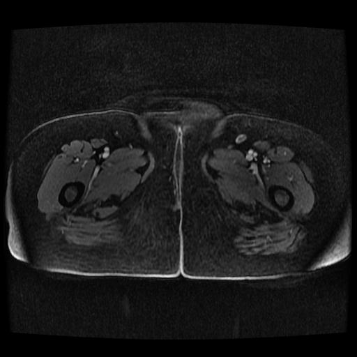 Cervical carcinoma (Radiopaedia 70924-81132 Axial T1 C+ fat sat 98).jpg