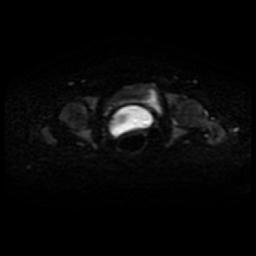 Cervical carcinoma (Radiopaedia 88010-104555 Axial DWI 27).jpg