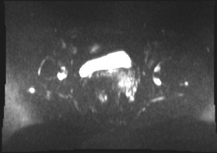 File:Cervical carcinoma (Radiopaedia 88312-104943 Axial DWI 14).jpg