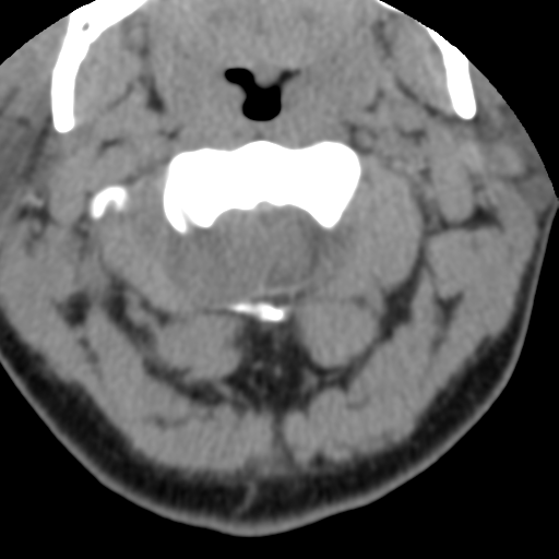 Cervical schwannoma (Radiopaedia 57979-64974 Axial non-contrast 18).png