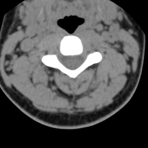 Cervical schwannoma (Radiopaedia 57979-64974 Axial non-contrast 27).png