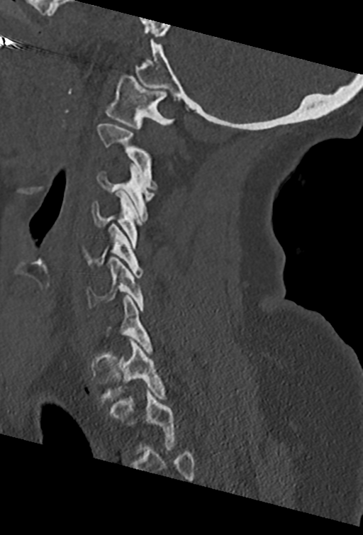 Cervical spine ACDF loosening (Radiopaedia 48998-54070 Sagittal bone window 58).png