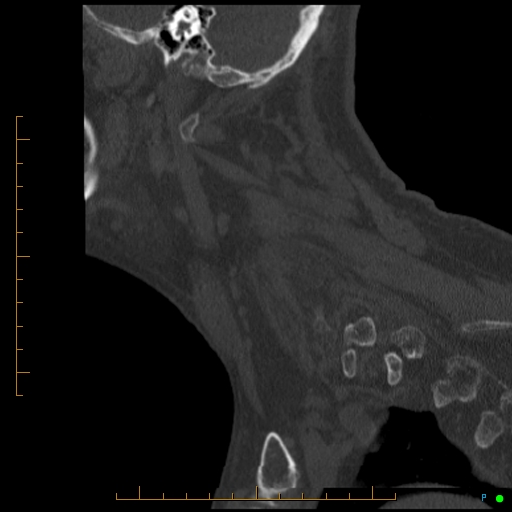 Cervical spine fracture - ankylosing spondylitis (Radiopaedia 76835-88706 Sagittal bone window 23).jpg
