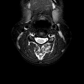 File:Cervical spine posterior ligamentous complex rupture (Radiopaedia 63486-72103 Axial T2 14).jpg