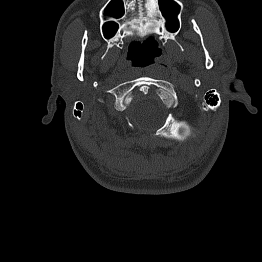 File:Cervical spine trauma with tear drop fracture and perched facet joint (Radiopaedia 53989-60127 Axial bone window 4).jpg