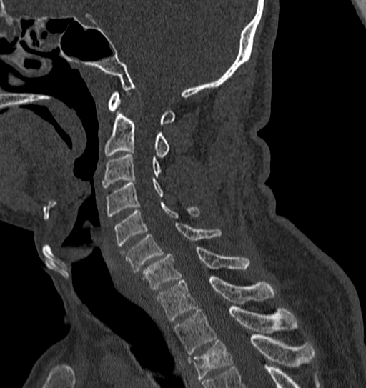 Cervical spine trauma with tear drop fracture and perched facet joint (Radiopaedia 53989-60127 Sagittal bone window 71).jpg