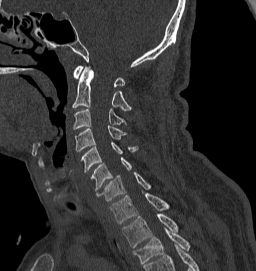 Cervical spine trauma with tear drop fracture and perched facet joint (Radiopaedia 53989-60127 Sagittal bone window 91).jpg